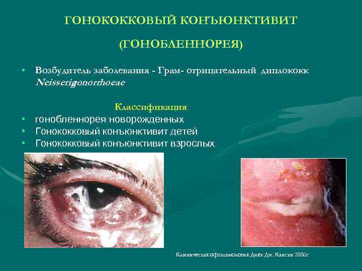 ГОНОКОККОВЫЙ КОНЪЮНКТИВИТ (ГОНОБЛЕННОРЕЯ) • Возбудитель заболевания - Грам- отрицательный диплококк Neisseria gonorrhoeae. Классификация •