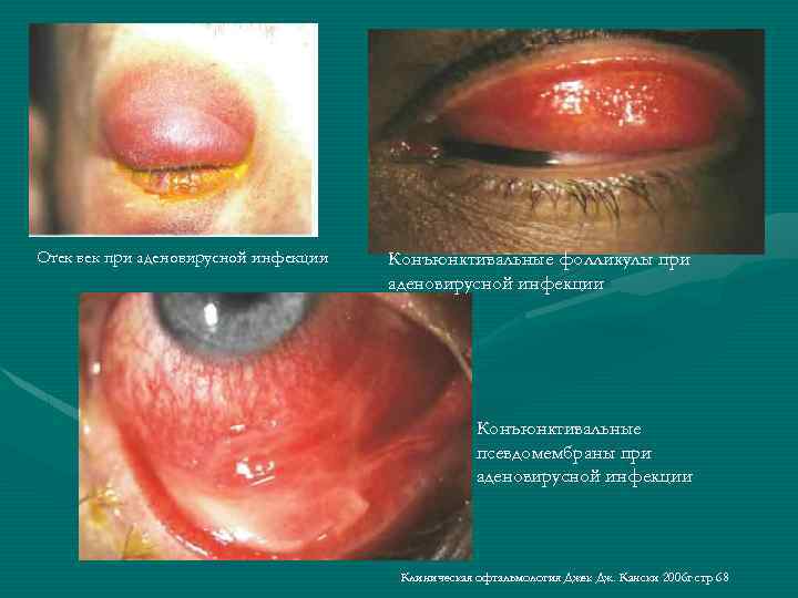 Отек век при аденовирусной инфекции Конъюнктивальные фолликулы при аденовирусной инфекции Конъюнктивальные псевдомембраны при аденовирусной