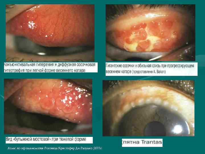 Атлас по офтальмологии Роговица Кристофер Дж Рапуано , 2011 г. 