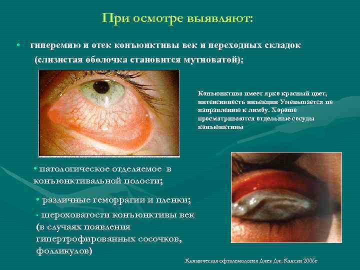 При осмотре выявляют: • гиперемию и отек конъюнктивы век и переходных складок (слизистая оболочка