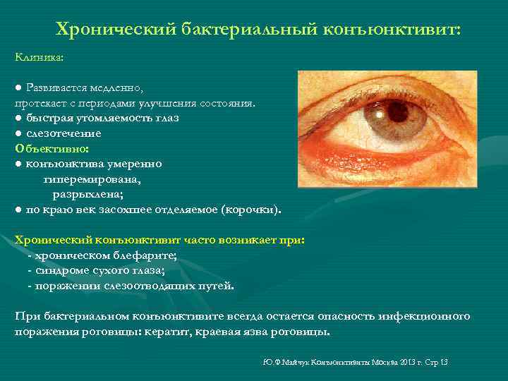 Хронический бактериальный конъюнктивит: Клиника: ● Развивается медленно, протекает с периодами улучшения состояния. ● быстрая