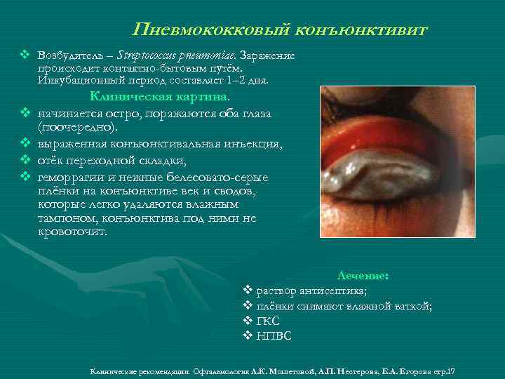 Пневмококковый конъюнктивит v Возбудитель – Streptococcus pneumoniae. Заражение происходит контактно-бытовым путём. Инкубационный период составляет