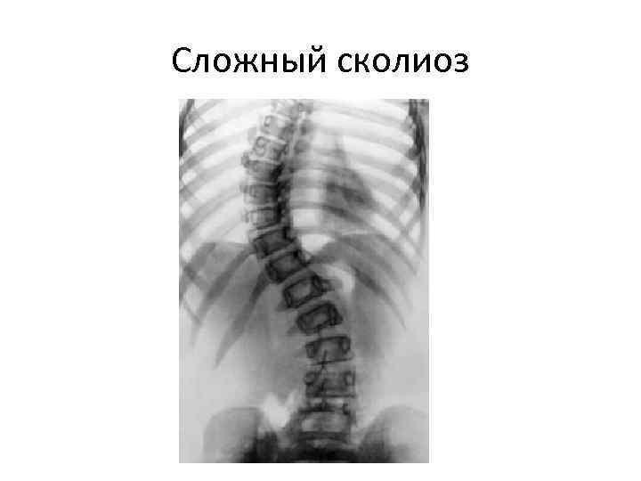 Сложный сколиоз 