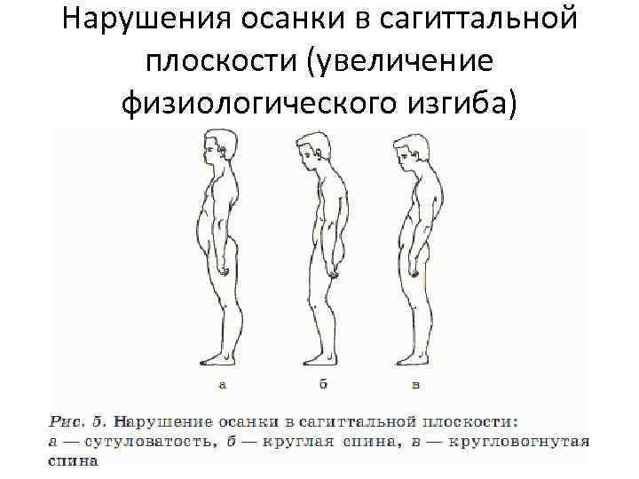 Рассмотрите рисунки 1 4 с изображением типов осанок человека как называют нарушение осанки