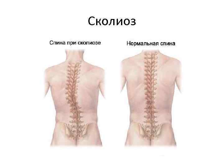 Сколиоз 