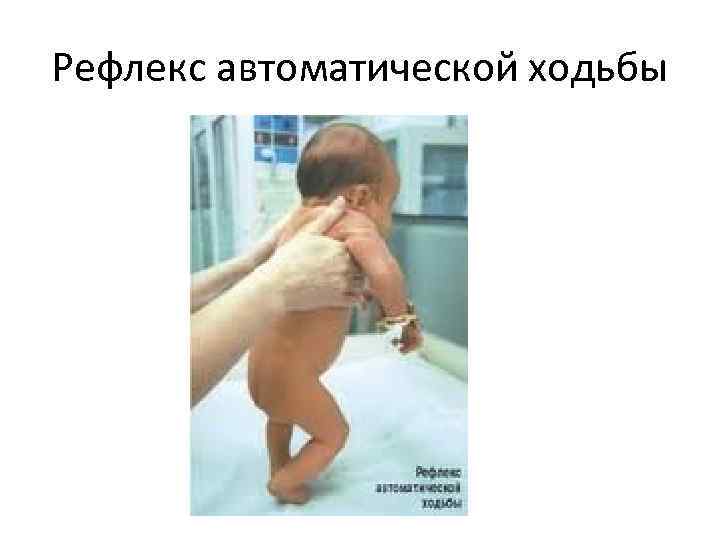 Рефлекс автоматической ходьбы 