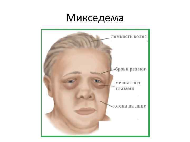 Микседема что за болезнь. Микседема щитовидной железы. Первичная микседема (тиреотоксикоз);. Гипотиреозе отеки (микседема).