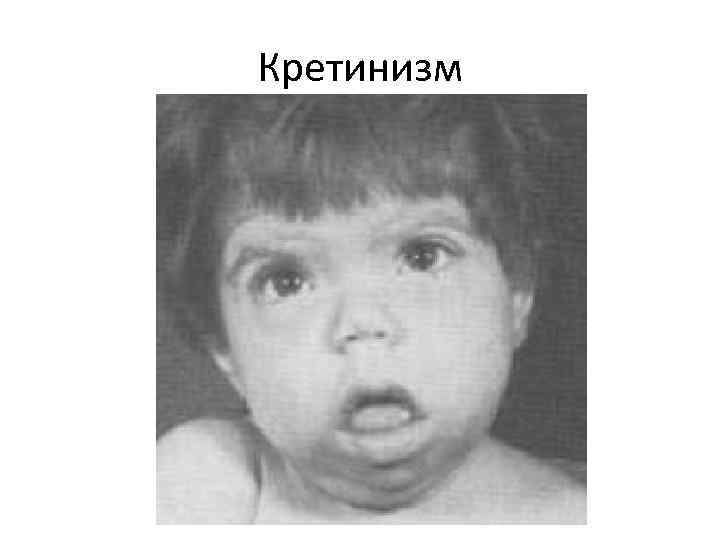 Кретинизм 