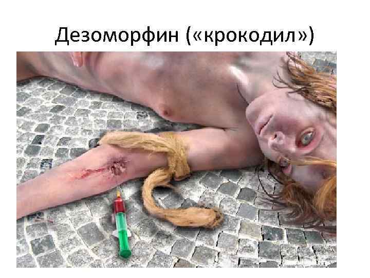 Дезоморфин ( «крокодил» ) 
