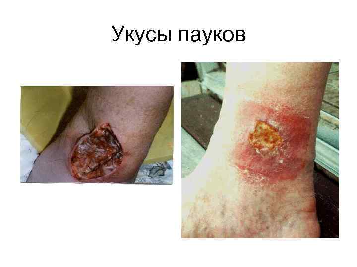 Укусы пауков 