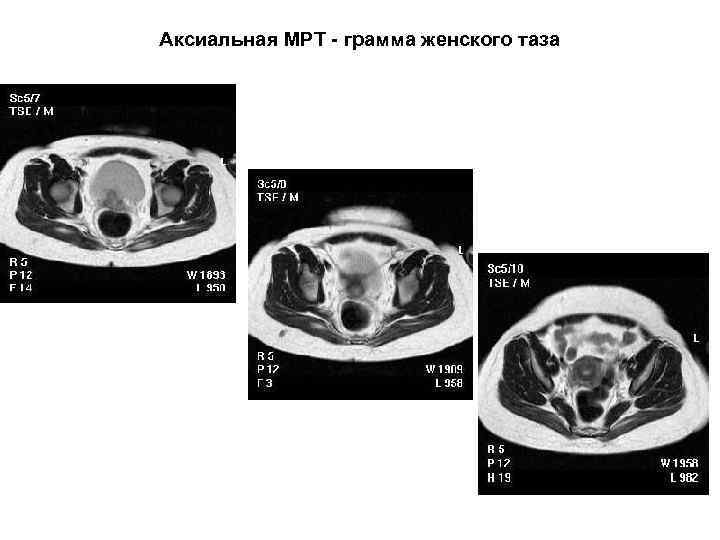 Аксиальная МРТ - грамма женского таза 