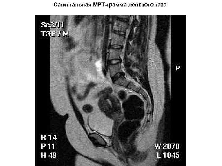 Сагиттальная МРТ-грамма женского таза 