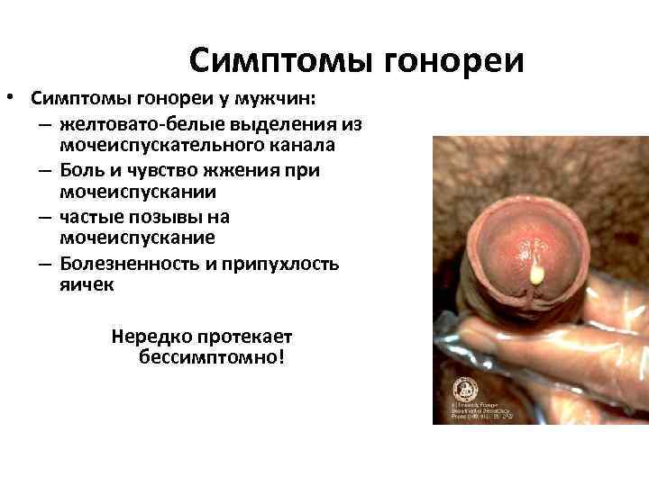     Симптомы гонореи • Симптомы гонореи у мужчин: – желтовато-белые выделения