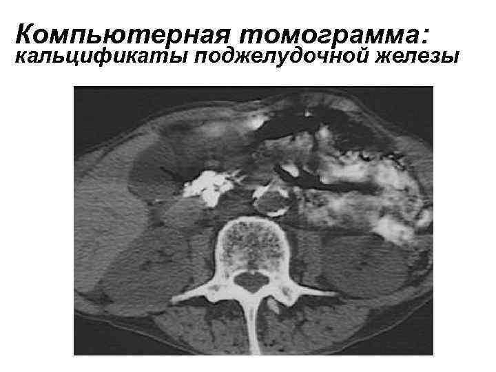 Мрт поджелудочной железы. Нейроэндокринные опухоли поджелудочной железы кт-картина. Кт поджелудочной железы кальцификаты. Мрт снимки поджелудочной железы. Опухоль поджелудочной железы на рентгене.