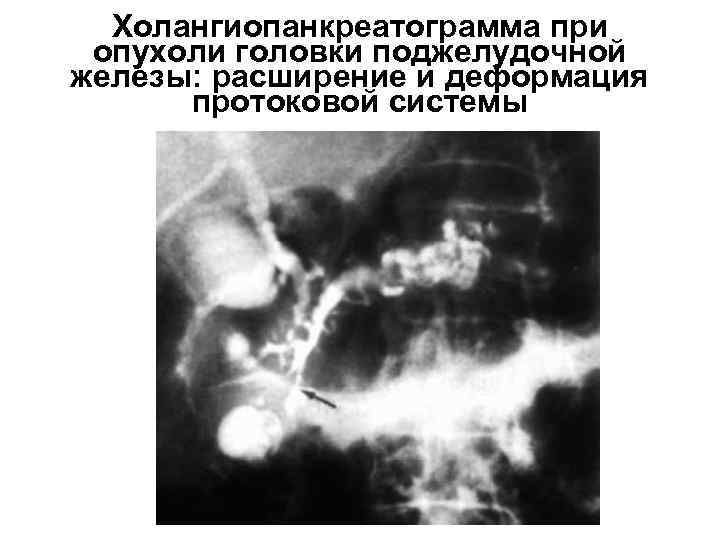 Холангиопанкреатограмма при опухоли головки поджелудочной железы: расширение и деформация протоковой системы 