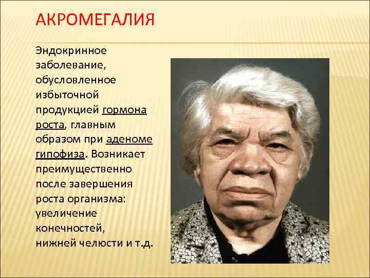 АКРОМЕГАЛИЯ Эндокринное заболевание, обусловленное избыточной продукцией гормона роста, главным образом при аденоме гипофиза. Возникает