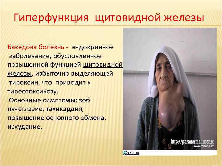 Гиперфункция щитовидной железы Базедова болезнь - эндокринное заболевание, обусловленное повышенной функцией щитовидной железы, избыточно