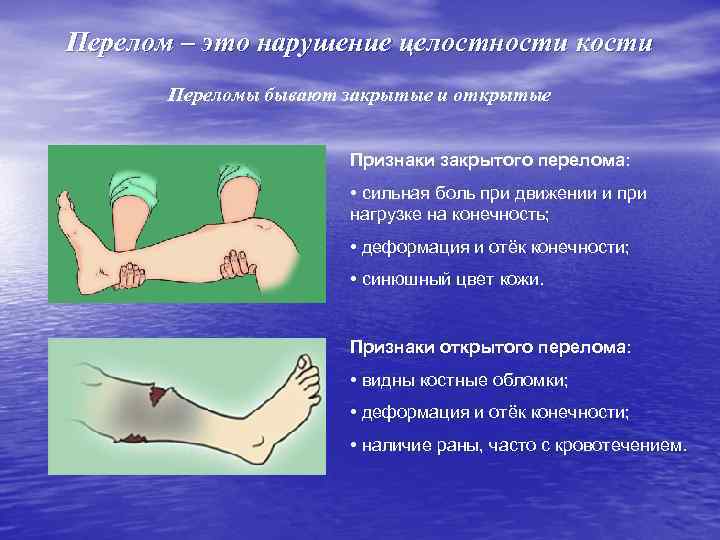 Перелом – это нарушение целостности кости Переломы бывают закрытые и открытые Признаки закрытого перелома: