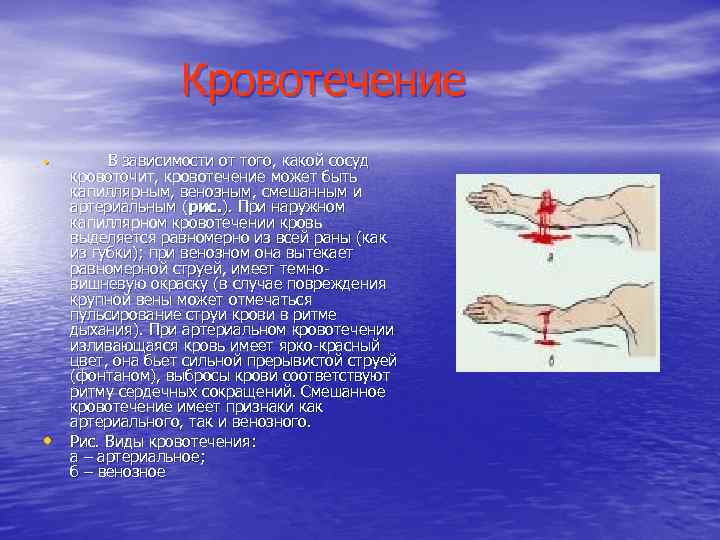 Кровотечение • • В зависимости от того, какой сосуд кровоточит, кровотечение может быть