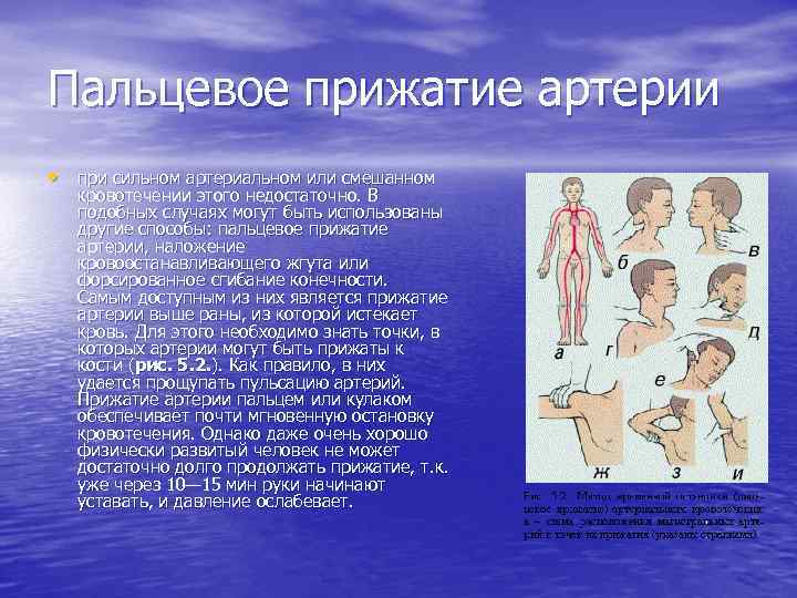 Пальцевое прижатие артерии • при сильном артериальном или смешанном кровотечении этого недостаточно. В подобных