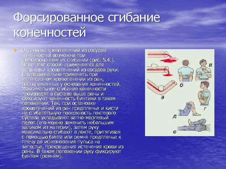 Форсированное сгибание конечностей • Остановка кровотечений из сосудов конечностей возможна при форсированном их сгибании