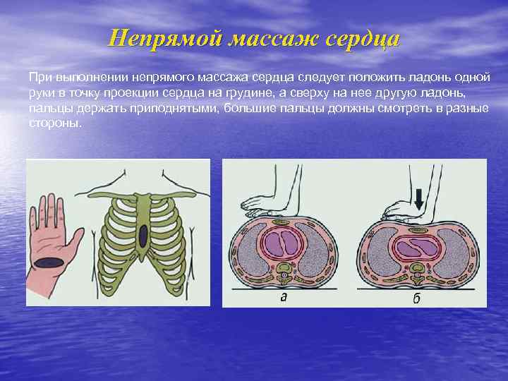 Непрямой массаж сердца При выполнении непрямого массажа сердца следует положить ладонь одной руки в