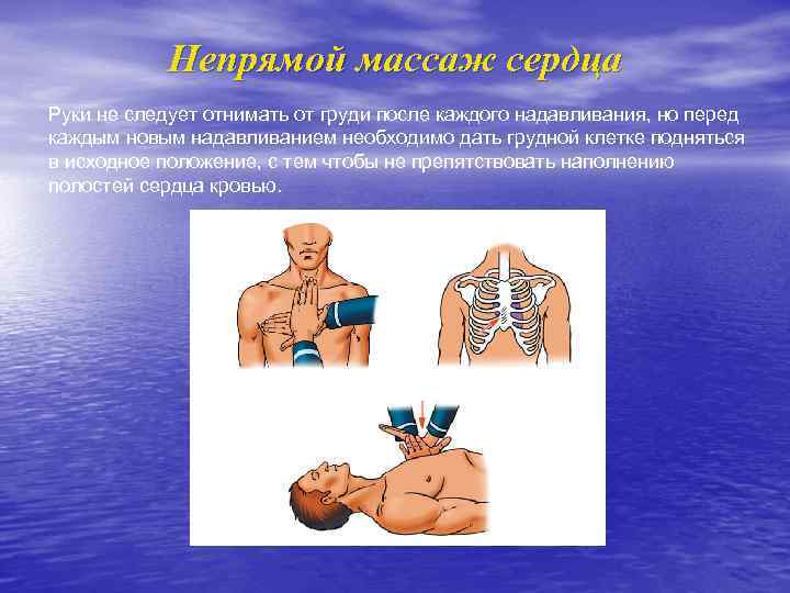 Непрямой массаж сердца Руки не следует отнимать от груди после каждого надавливания, но перед