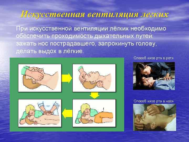 Искусственная вентиляция легких При искусственной вентиляции лёгких необходимо обеспечить проходимость дыхательных путей: зажать нос