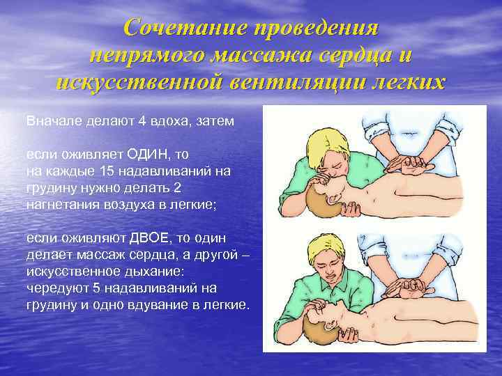 Сочетание проведения непрямого массажа сердца и искусственной вентиляции легких Вначале делают 4 вдоха, затем