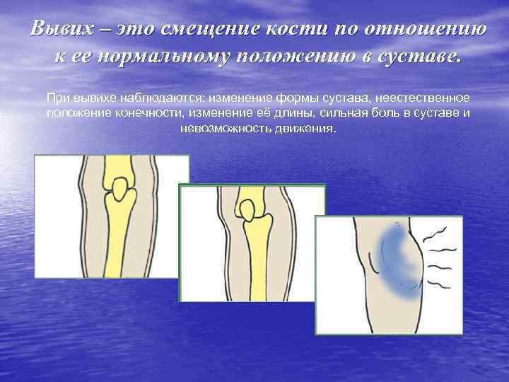 Вывих – это смещение кости по отношению к ее нормальному положению в суставе. При
