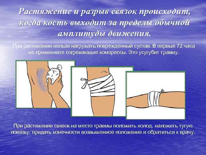 Растяжение и разрыв связок происходит, когда кость выходит за пределы обычной амплитуды движения. При