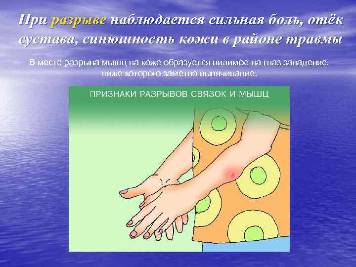 При разрыве наблюдается сильная боль, отёк сустава, синюшность кожи в районе травмы В месте