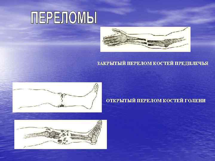 ЗАКРЫТЫЙ ПЕРЕЛОМ КОСТЕЙ ПРЕДПЛЕЧЬЯ ОТКРЫТЫЙ ПЕРЕЛОМ КОСТЕЙ ГОЛЕНИ 