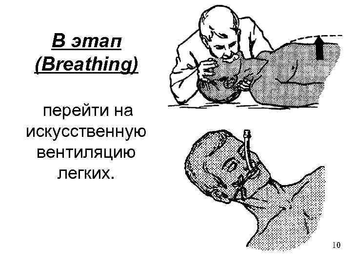 B этап (Breathing) перейти на искусственную вентиляцию легких. 10 