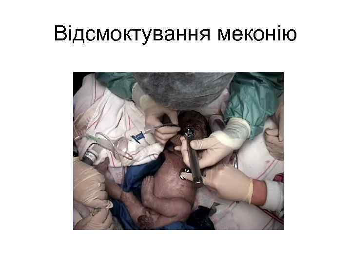 Відсмоктування меконію 