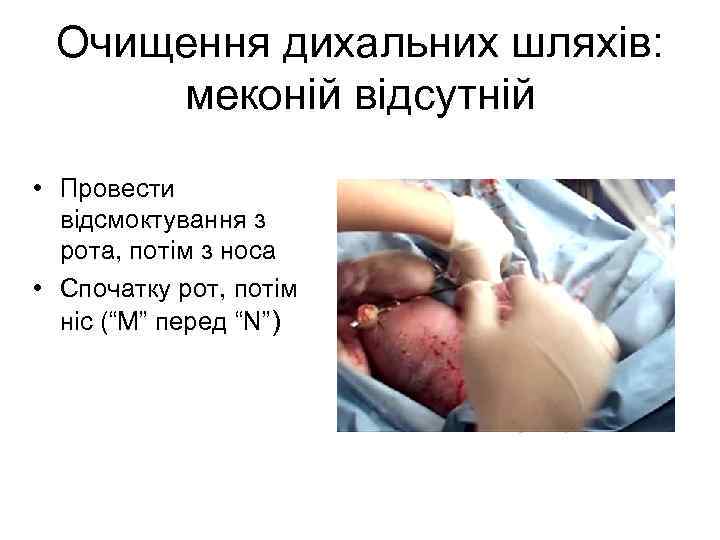 Очищення дихальних шляхів: меконій відсутній • Провести відсмоктування з рота, потім з носа •