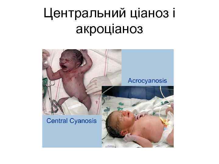 Центральний ціаноз і акроціаноз 