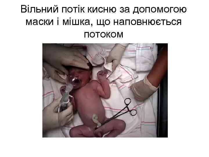 Вільний потік кисню за допомогою маски і мішка, що наповнюється потоком 