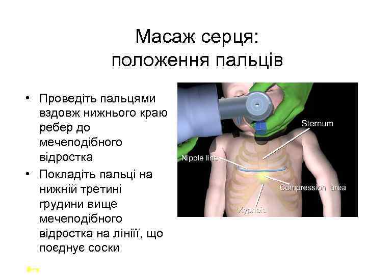 Масаж серця: положення пальців • Проведіть пальцями вздовж нижнього краю ребер до мечеподібного відростка