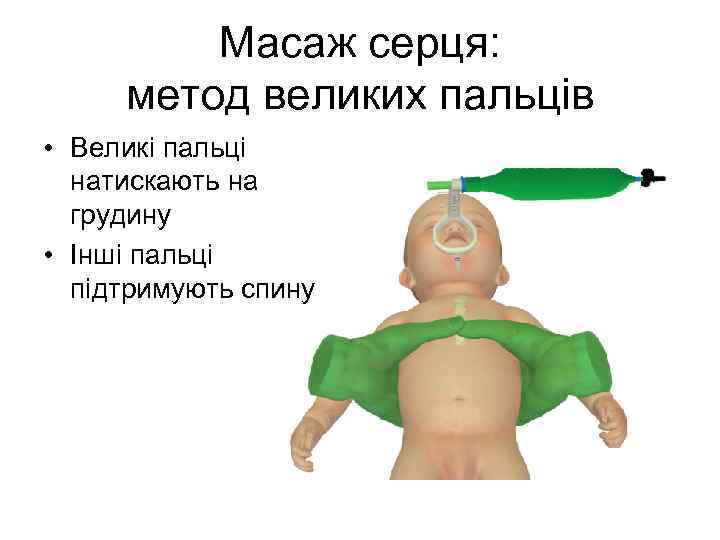 Масаж серця: метод великих пальців • Великі пальці натискають на грудину • Інші пальці