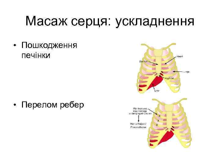 Масаж серця: ускладнення • Пошкодження печінки • Перелом ребер 