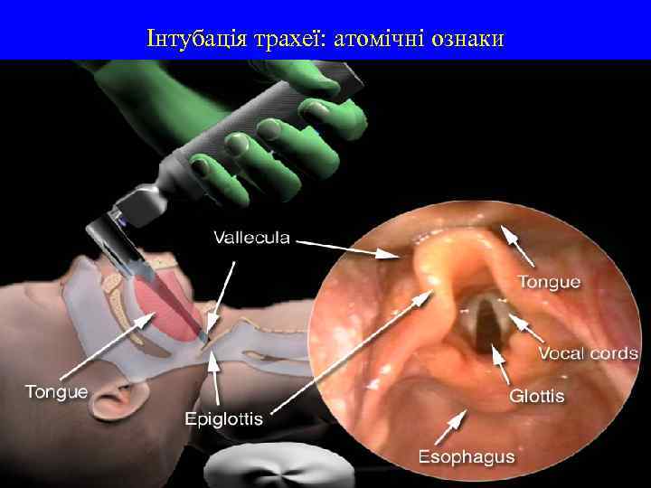 Інтубація трахеї: атомічні ознаки 