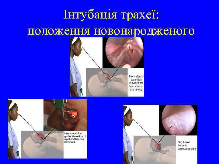 Інтубація трахеї: положення новонародженого 