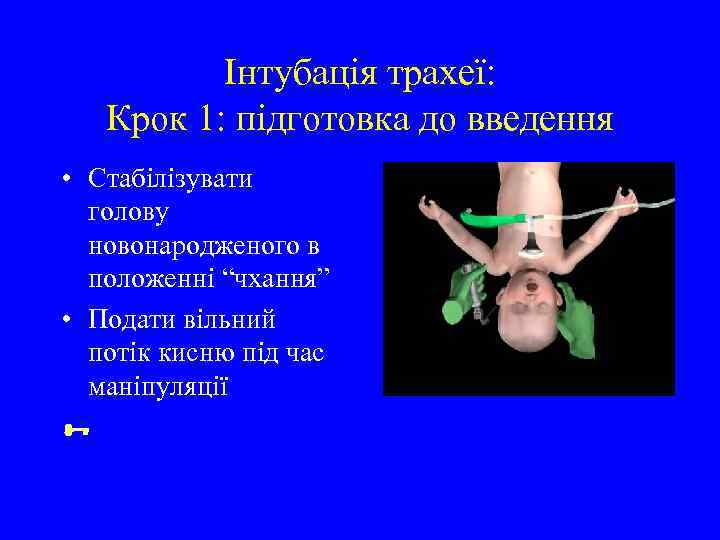 Інтубація трахеї: Крок 1: підготовка до введення • Стабілізувати голову новонародженого в положенні “чхання”