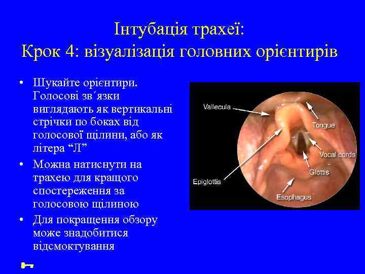 Інтубація трахеї: Крок 4: візуалізація головних орієнтирів • Шукайте орієнтири. Голосові зв΄язки виглядають як