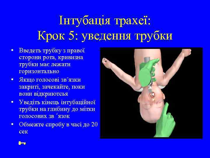 Інтубація трахеї: Крок 5: уведення трубки • Введеть трубку з правої сторони рота, кривизна