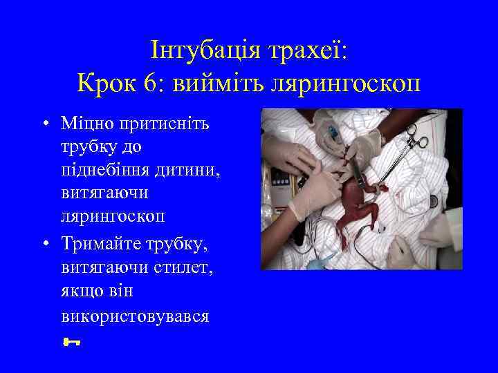 Інтубація трахеї: Крок 6: вийміть лярингоскоп • Міцно притисніть трубку до піднебіння дитини, витягаючи