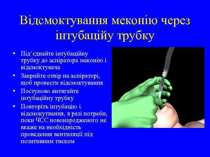 Відсмоктування меконію через інтубаційу трубку • Під΄єднайте інтубаційну трубку до аспіратора меконію і відсмоктувача