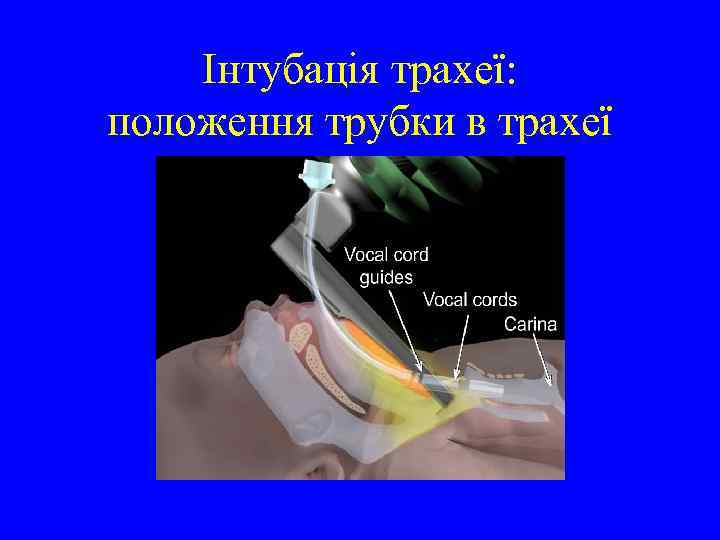 Інтубація трахеї: положення трубки в трахеї 
