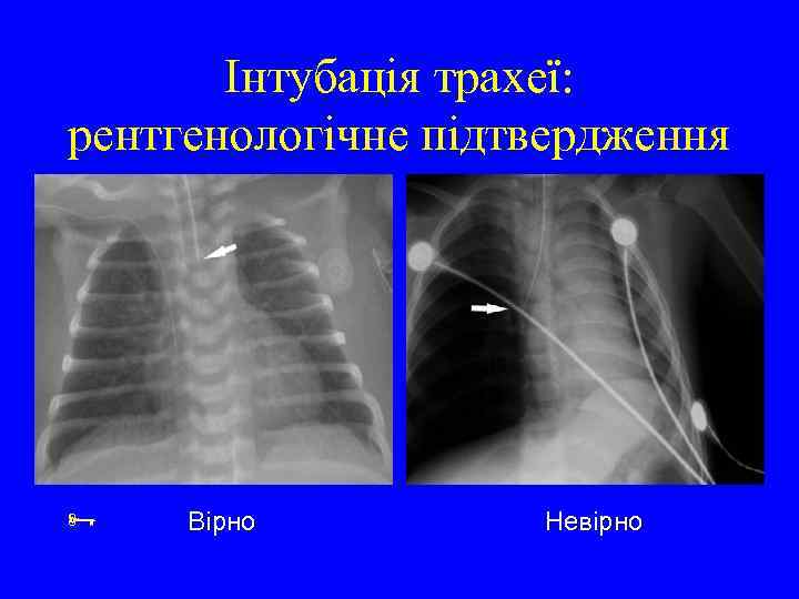 Інтубація трахеї: рентгенологічне підтвердження Вірно Невірно 